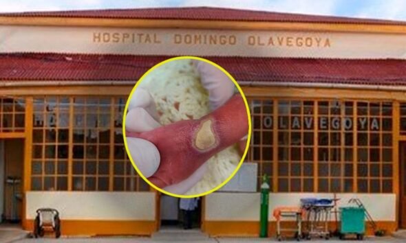 Investigan presunta negligencia médica tras quemadura de tercer grado en recién nacida en hospital